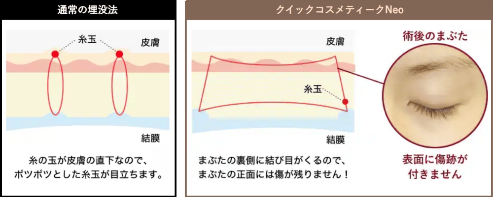 その②傷跡ゼロ・即メイクOK